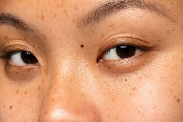 ลักษณะฝ้า